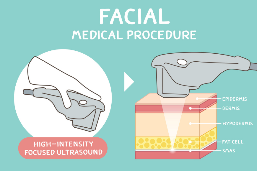 Hifu treatment in Dubai Hifu treatment in Dubai