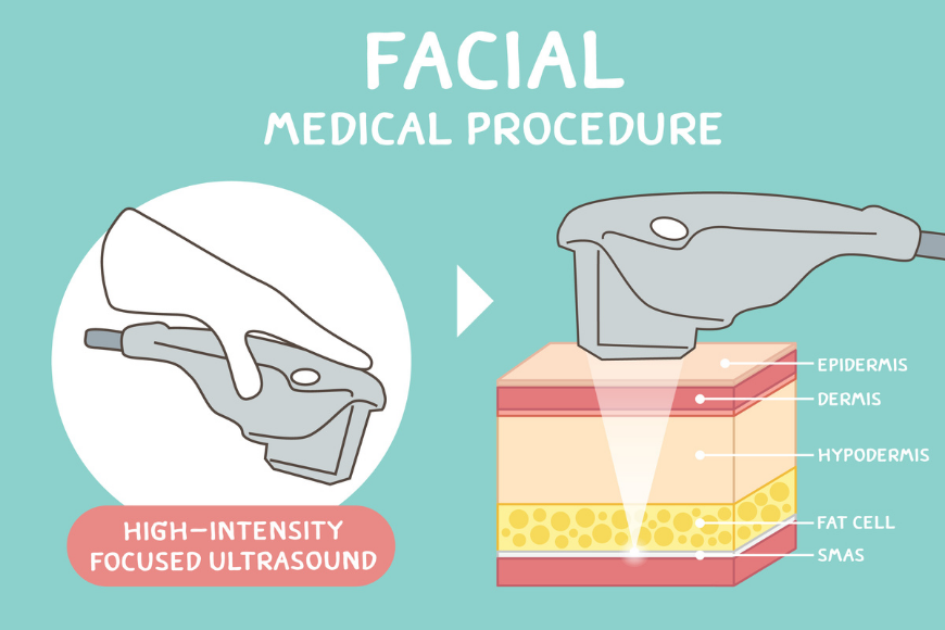 Hifu treatment in Dubai