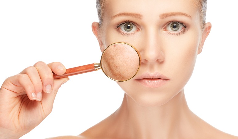 Melasma Melasma