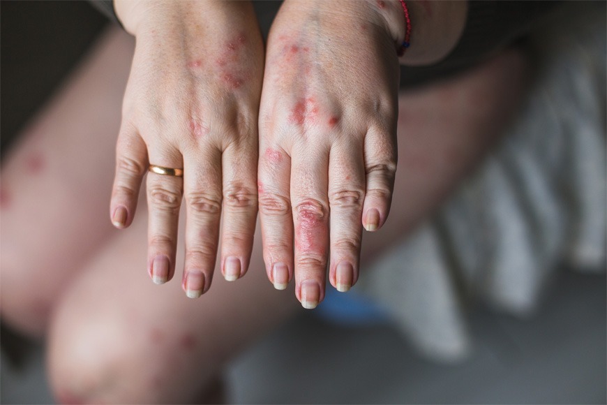 Psoriasis Psoriasis