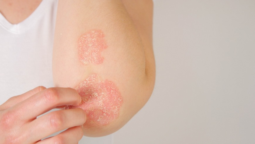 Psoriasis treatment in Dubai Psoriasis treatment in Dubai