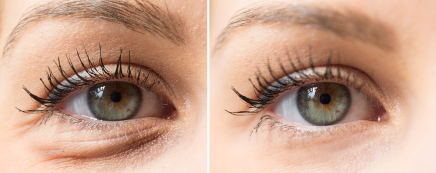 Under eye filler with free oxygen facial Dubai Under eye filler with free oxygen facial Dubai