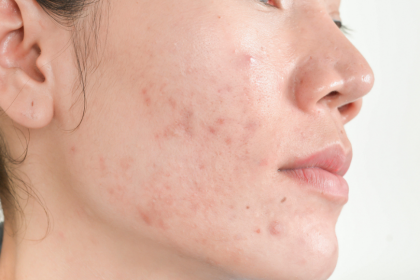 Acne Scars Treatment: RF Microneedling in Dubai | ExpatWoman.com